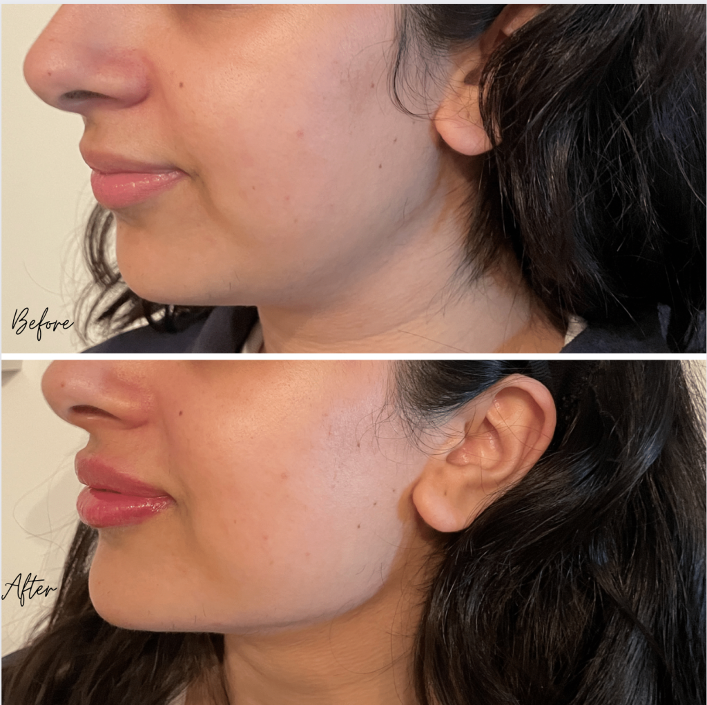 Before And After Of Jawline Filler — Persona Medical Aesthetics Skin And Laser Clinic 7414